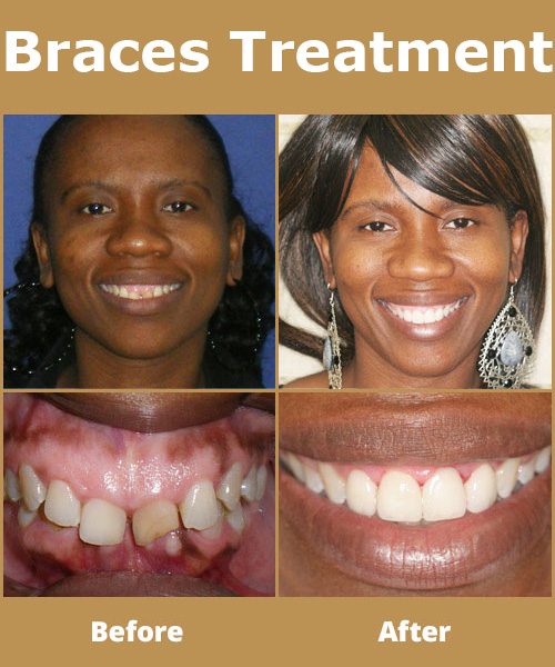 Before & After Braces  Caponera Orthodontics