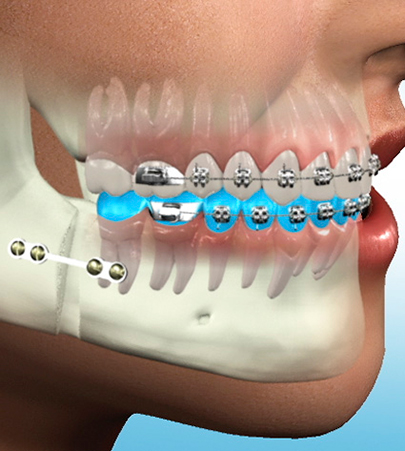 Surgical orthodontics