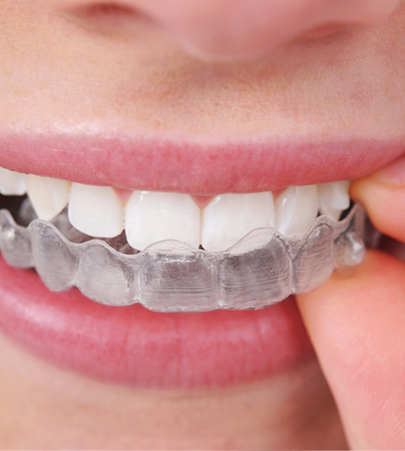 Why Invisalign is right for you